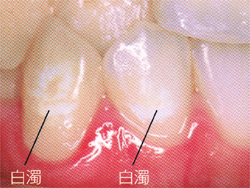 白濁（はくだく）した酸蝕歯