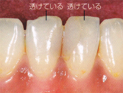 透き通った酸蝕歯