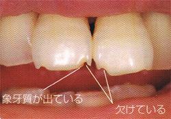 欠けて象牙質が出た酸蝕歯