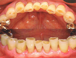 欠けて象牙質が出た酸蝕歯