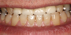 酸蝕歯 治療後