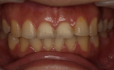 酸蝕歯 治療前
