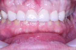 酸蝕歯 治療前