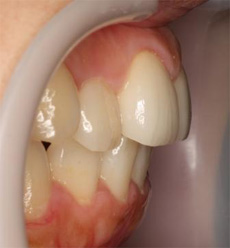 ジルコニアによる歯列矯正後